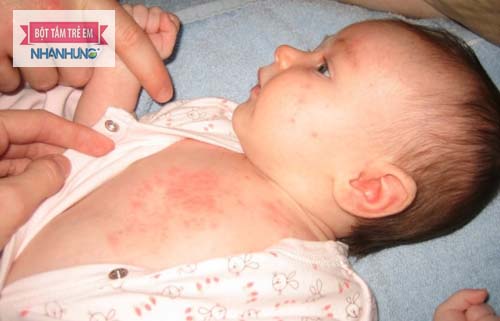Rôm sảy có thể tự khỏi nhưng tái phát cũng cao - Trẻ bị rôm sảy ở cổ