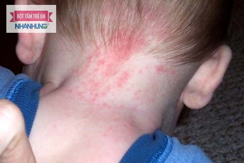 Rôm sảy thường khu trú ở vùng cố nhiều nếp gấp trên cơ thể trẻ - Bé bị rôm sảy ở cổ