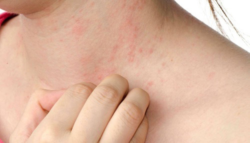 Khi bé bị rôm sảy - hạn chế trầy xước da cho bé bằng cách cắt móng tay thường xuyên cho bé