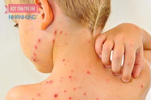 Bệnh sốt xuất huyết khiến bé bị sốt nổi mẩn đỏ khắp người