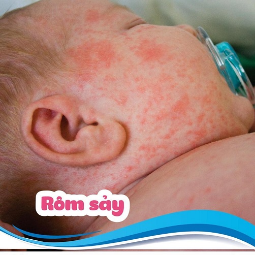 Hè đến rôm sảy là nguyên nhân chính khiến trẻ bị nổi mẩn đỏ ở mặt