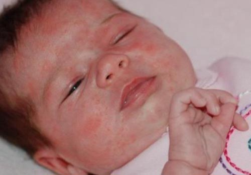 Bé sơ sinh bị nổi mẩn đỏ do nhiễm khuẩn, nhiễm trùng