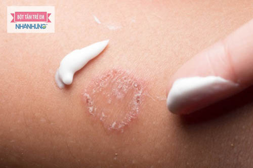 Cần tham khảo ý kiến bác sĩ trước khi dùng thuốc trị hắc lào