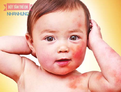 Bé bị mẩn ngứa do dị ứng thời tiết hoặc thực phẩm