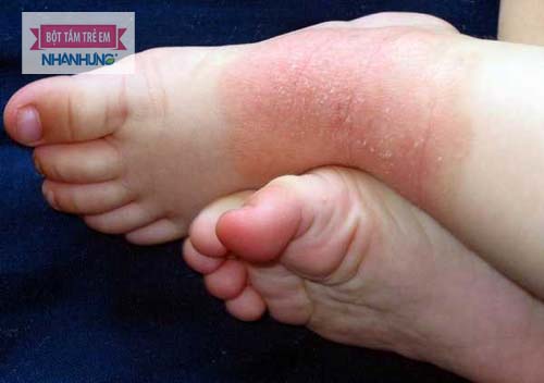 Đặc điểm của bệnh là xuất hiện mụn nước ở lòng bàn tay, bàn chân