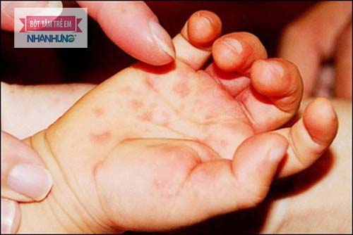 Bệnh tổ đỉa ở trẻ em khó điều trị dứt điểm và thường xuyên tái phát
