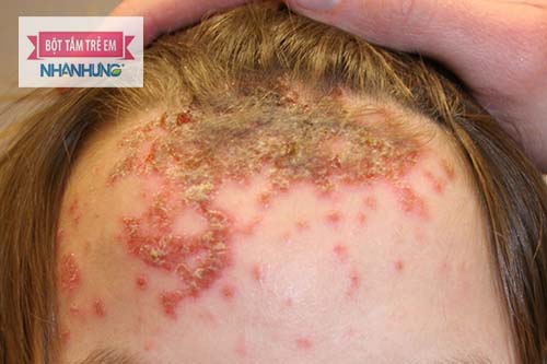 Bệnh chốc lây (chốc lở) thường xuất hiện ở đầu, cổ, mặt, chân, tay - Một thể bệnh của viêm da liên cầu