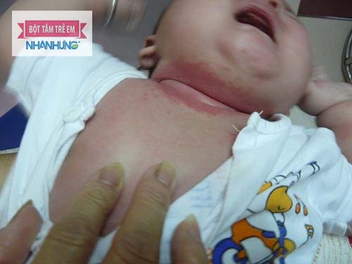 Hăm kẽ xuất hiện ở những vùng da nhiều nếp gấp như: cổ, bẹn, mông, sau tai, rốn… - Một trong những thể bệnh viêm da liên cầu