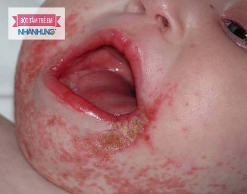 Viêm da liên cầu dạng chốc mép khiến trẻ đau rát, khó chịu - Điều trị bệnh viêm da liên cầu ở trẻ