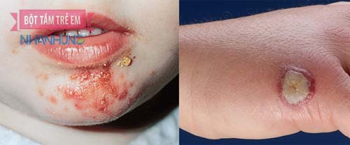 Bệnh viêm da tụ cầu ở trẻ thường khởi phát mạnh vào mùa hè
