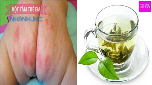 Hăm tã thường gặp ở 30% trẻ sơ sinh và trẻ nhỏ