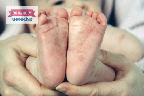 Trẻ bị ghẻ nước cần được vệ sinh sạch sẽ - Ghẻ nước ở trẻ