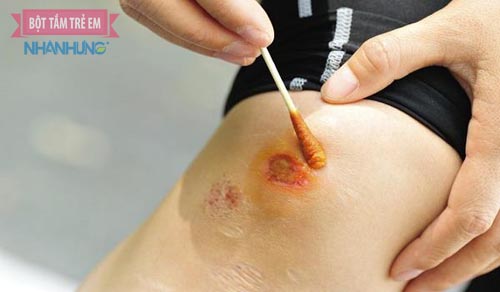 Cần sơ cứu kịp thời vết trầy xước ở đầu gối của trẻ