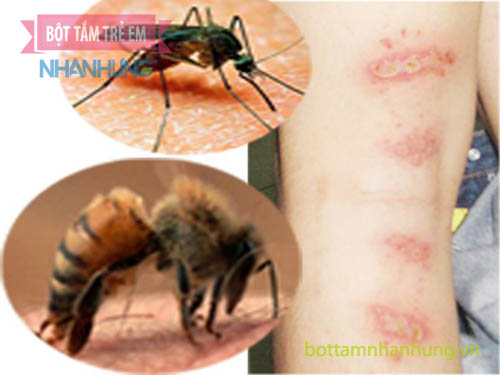 Bé bị nổi mẩn đỏ khắp người nhưng không sốt do côn trùng cắn