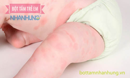 Bé bị nổi mẩn đỏ khắp người nhưng không sốt do dị ứng thuốc