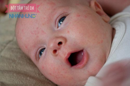 Mẩn ngứa khiến trẻ rất khó chịu