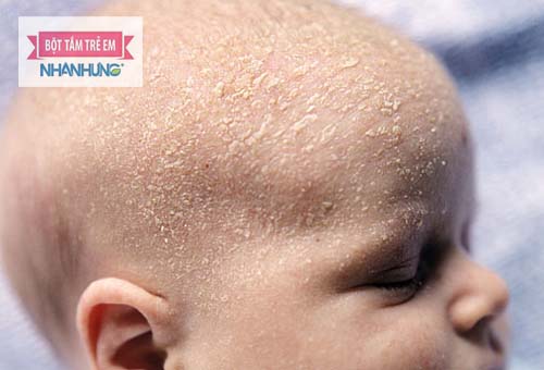 Lông mày, da đầu bé có vảy là dấu hiệu của bệnh cứt trâu - Lông mày trẻ sơ sinh có vảy trắng