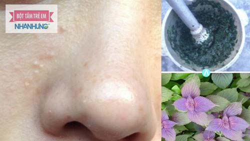 Có nhiều bài thuốc dân gian trị mụn thịt hiệu quả - điều trị mụn thịt ở trẻ em