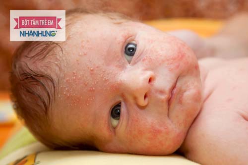 Rôm sảy thường mọc thành từng mảng đỏ trên da bé - Bé bị nổi mẩn đỏ ở mặt