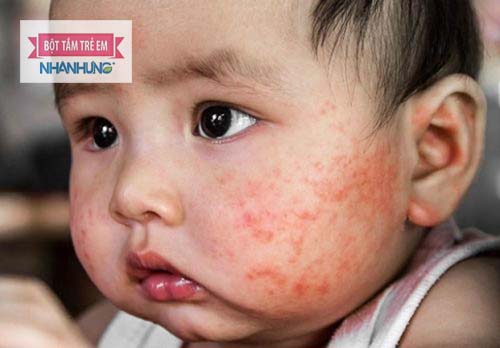 Chàm sữa khiến hai má bé nổi mẩn đỏ, ngứa ngáy - Bé bị nổi mẩn đỏ ở mặt