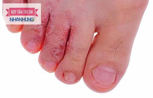 Nước ăn chân là bệnh lý về da rất thường gặp mùa mưa, ẩm