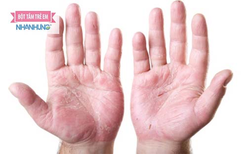 Biểu hiện nước ăn tay