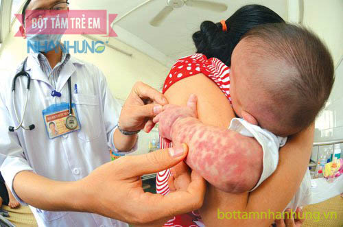 Bé bị nổi mẩn đỏ khắp người nhưng không sốt sau phát ban