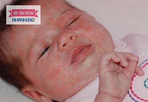 Trẻ có thể bị dị ứng dù mới chào đời