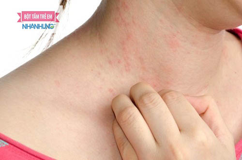 Thuốc kháng histamin H1 chuyên điều trị các bệnh lý dị ứng ngoài da