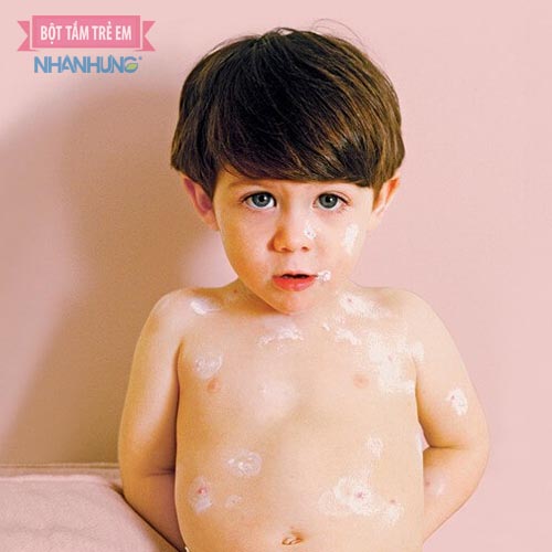 Trẻ bị dị ứng nổi mề đay cần được chăm sóc da đúng cách