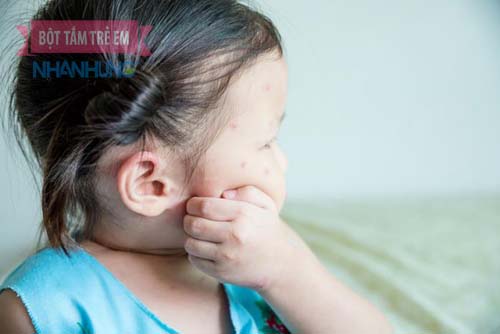 Gãi, nặn, cào cấu khiến vết đốt côn trùng trầm trọng hơn