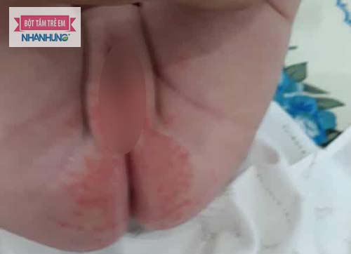 Bé trai hay bé gái cũng có thể bị hăm đỏ ở vùng kín - Bé bị hăm ở vùng kín