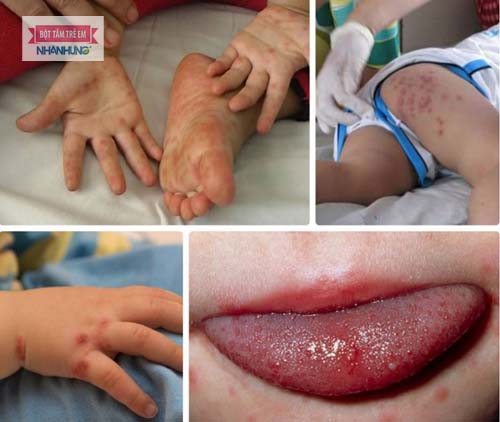 Theo dõi sát sao bệnh tình của trẻ để kịp thời điều trị - Tay chân miệng có tắm được không