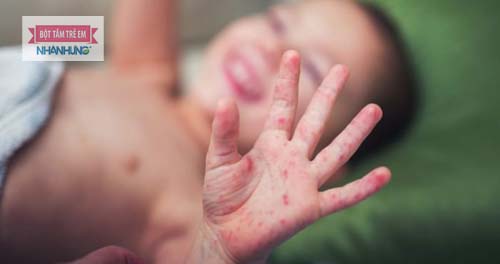 Trẻ bị tay chân miệng cần được tắm rửa hàng ngày để diệt khuẩn