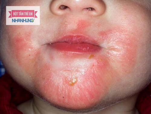 Trẻ sơ sinh bị viêm da cơ địa ở mặt là bệnh khó chữa và thường xuyên tái phát - Trẻ sơ sinh bị viêm da mặt