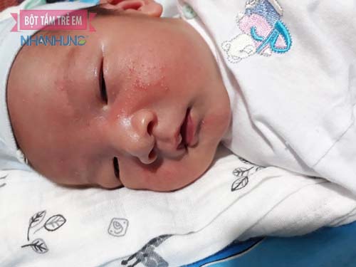 Bé sơ sinh nổi mụn đầu trắng trên mặt là hiện tượng sinh lý bình thường