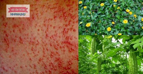 Khổ qua, sài đất… là những loại lá tắm có tác dụng điều trị rôm sảy - Trị rôm sảy ở người lớn