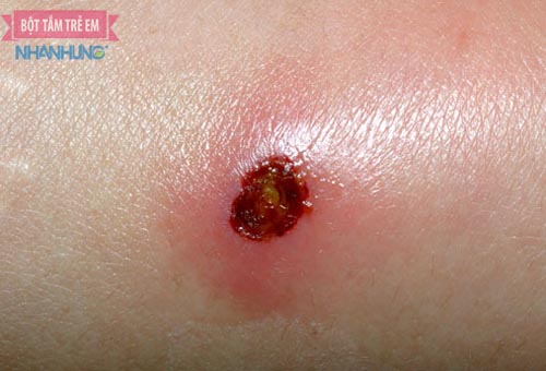Sức đề kháng yếu là điều kiện cho vi khuẩn xâm nhập vào vết trầy xước