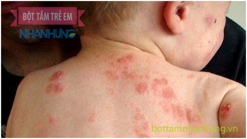Bé bị nổi mẩn đỏ khắp người nhưng không sốt do viêm da