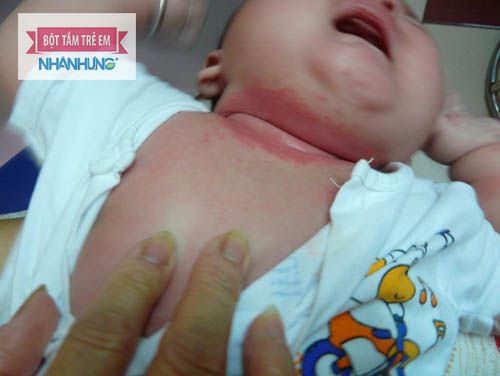 Không vệ sinh sạch sẽ trẻ dễ bị hăm kẽ