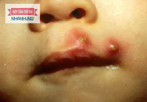 Viêm da mủ là bệnh lý phổ biến ở trẻ