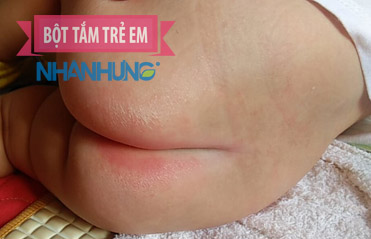 Hình ảnh bé bị hăm tã ở khu vực hậu môn, lỗ đít