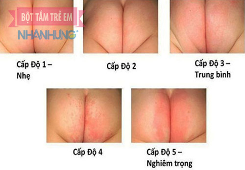 hăm tã ở trẻ trải qua 5 cấp độ