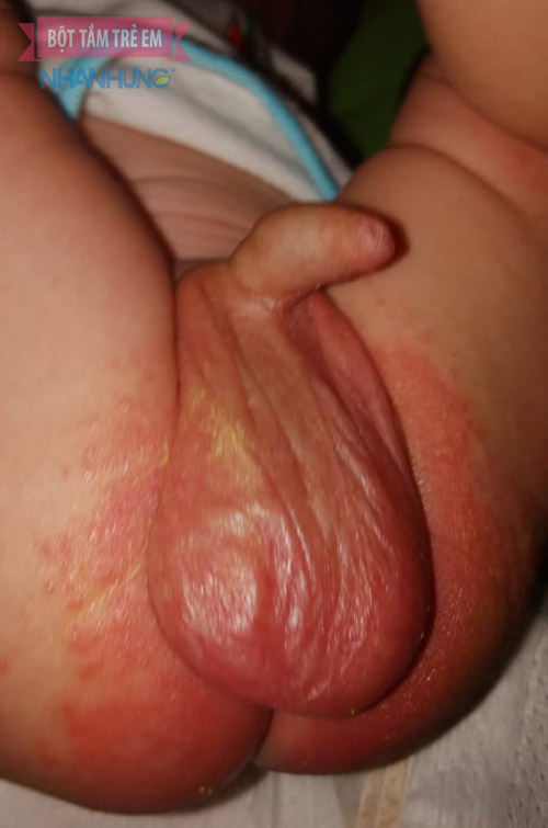 Hình ảnh bé bị hăm tã ở vùng kín