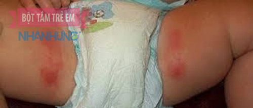 Mặc bỉm tã chật cũng dễ gây hăm cho bé