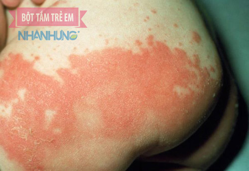 Hình ảnh bé bị hăm tã ở mông