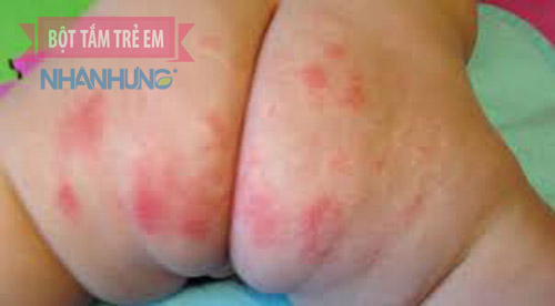 Hình ảnh bé bị hăm tã ở mông