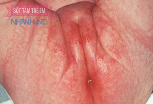 Hình ảnh bé bị hăm tã ở vùng kín