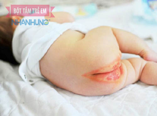 Hình ảnh bé bị hăm tã ở khu vực hậu môn