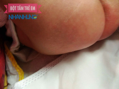 Hình ảnh trẻ sơ sinh bị hăm tã